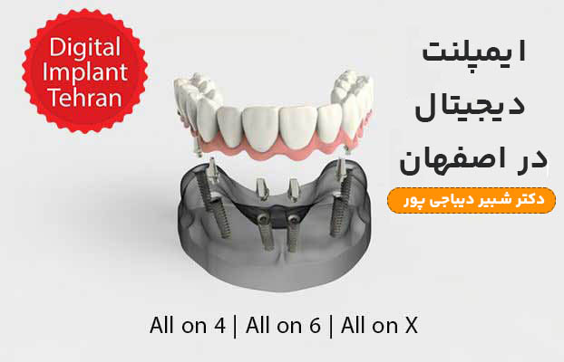 The best digital implant doctor in Isfahan + installments and without pain