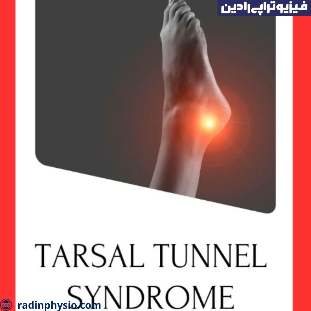 What is ankle tarsal tunnel syndrome? Radin Physiotherapy Clinic