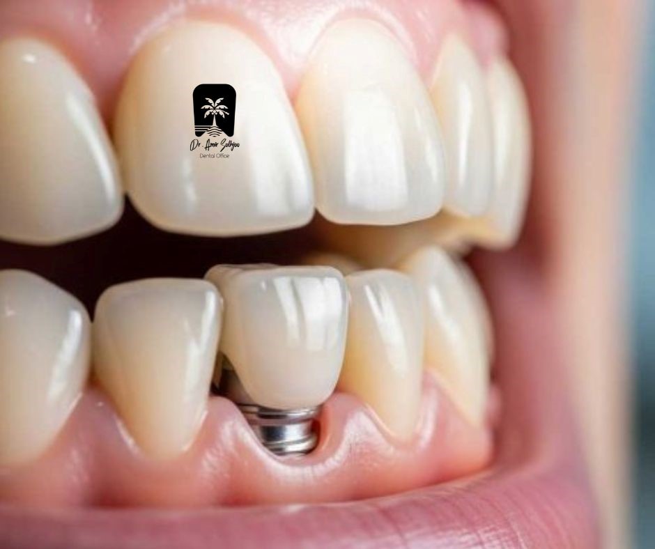 تصحيح تصميم الابتسامة بالزرعات: تطور حديث في جماليات الأسنان ووظيفتها