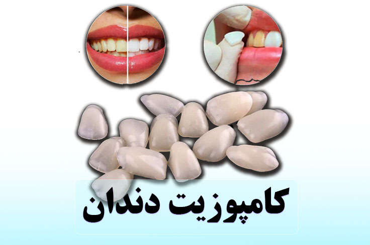 What is dental composite? (16 top brands + advantages and disadvantages)