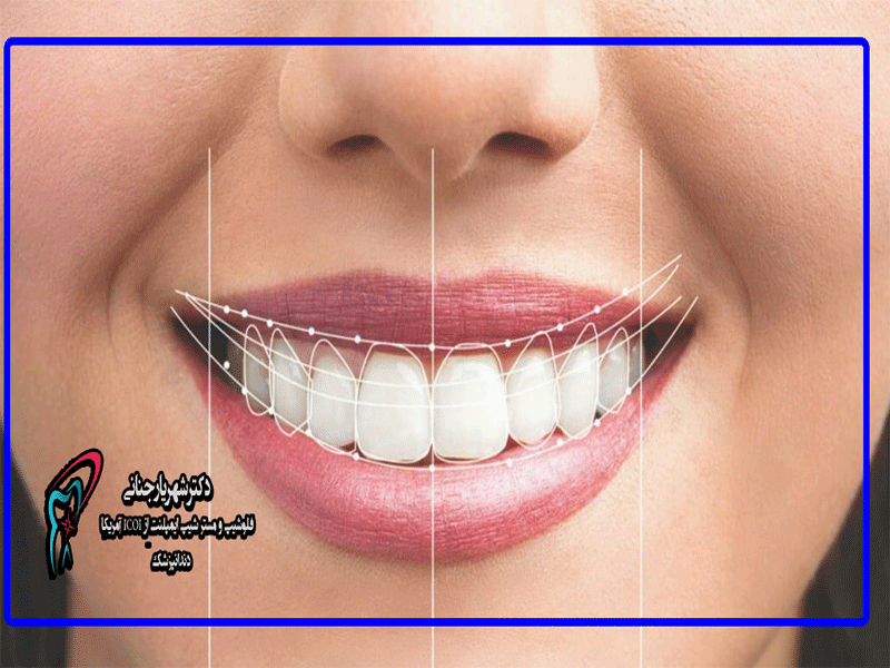 صفائح الأسنان في كرج