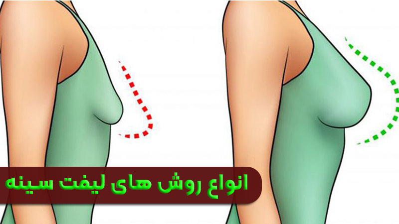 أنواع طرق رفع الثدي (Mastopexy)