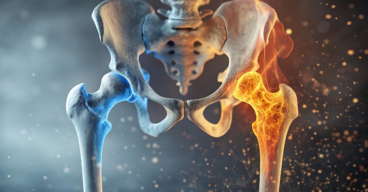 هشاشة العظام. مرض العظام الصامت - د. حسين اتحاد