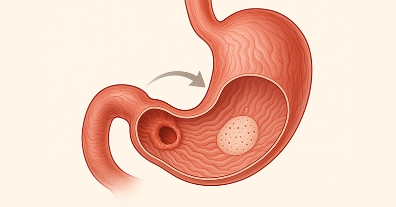 What should we eat after gastric ulcer surgery?