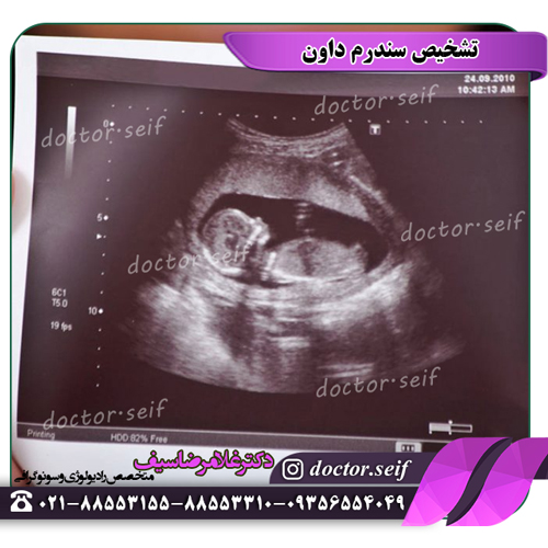 تشخیص سندرم داون