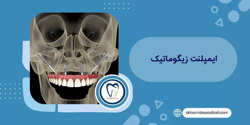 ما هي الغرسة الوجنية؟ مراجعة من 0 إلى 100 | دكتور حميدرضا أفضلي