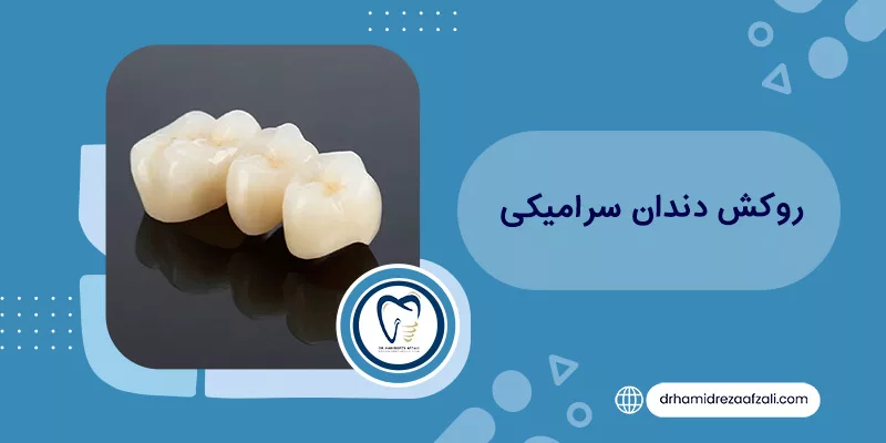 قشرة الأسنان الخزفية - استعراض المزايا والعيوب + السعر دكتور أفضلي