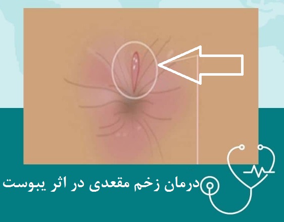 The best ointment for the treatment of anal ulcers caused by constipation