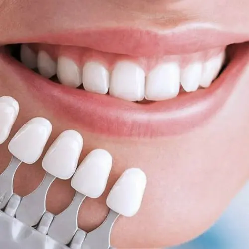 لمینت دندان [انواع، مراحل، مزایا، هزینه] + مشاوره تخصصی