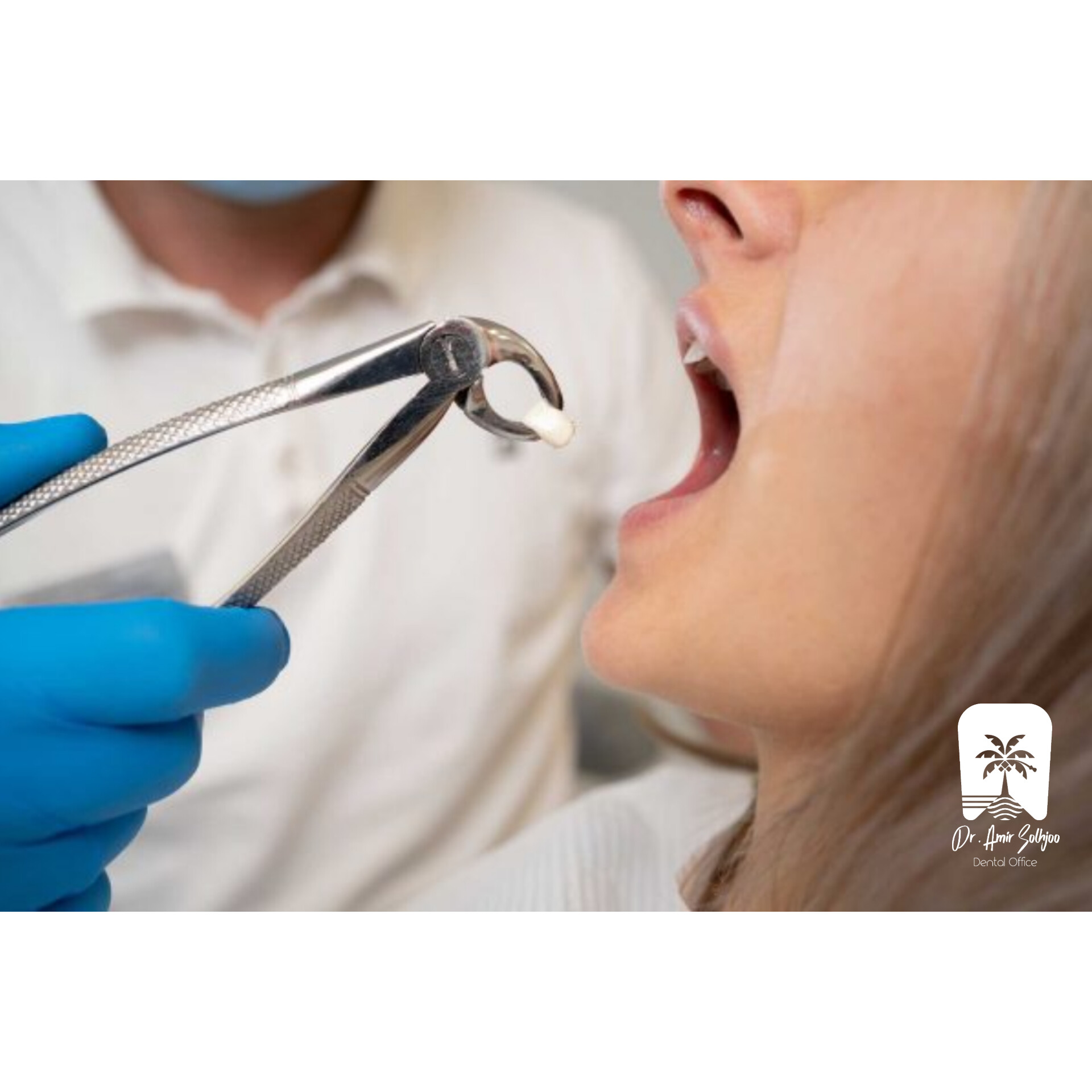 وقت خلع ضرس العقل