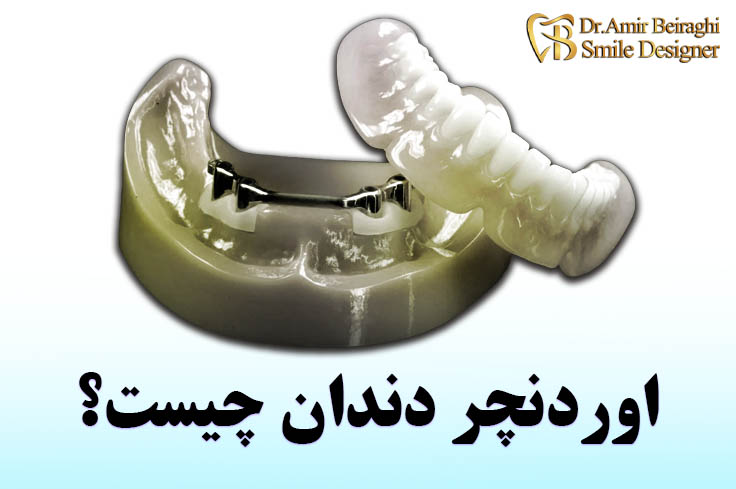 اوردنچر چیست؟ (قیمت آردنتور 1404 + عکس)