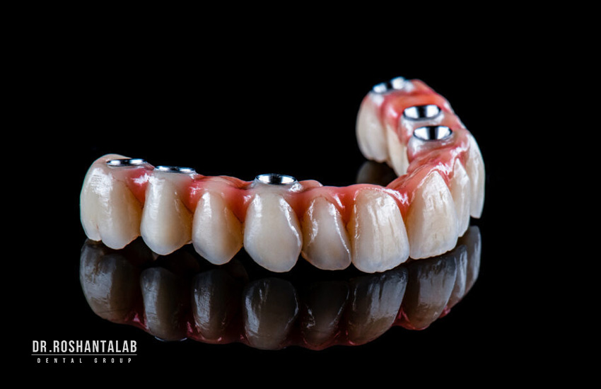انواع روکش ایمپلنت دندان (3 دسته): فواید و طول عمر آن