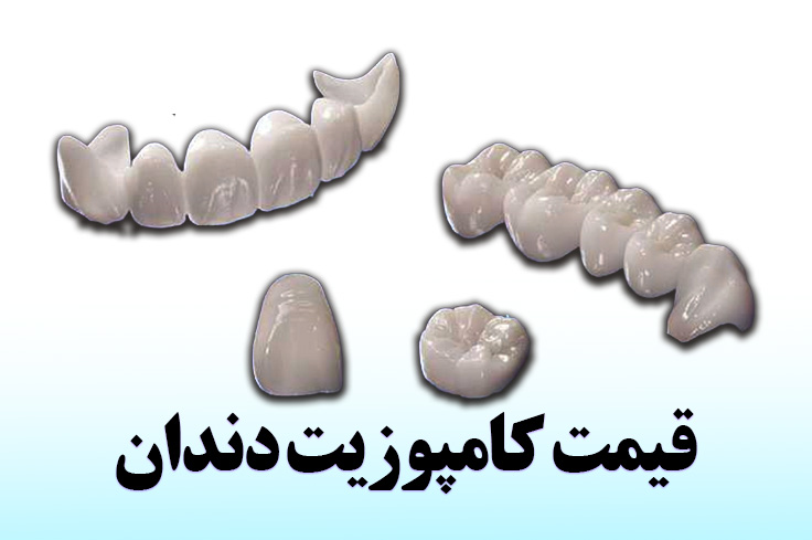 قیمت کامپوزیت دندان 1404 بهترین مارک + کامپوزیت اقساطی