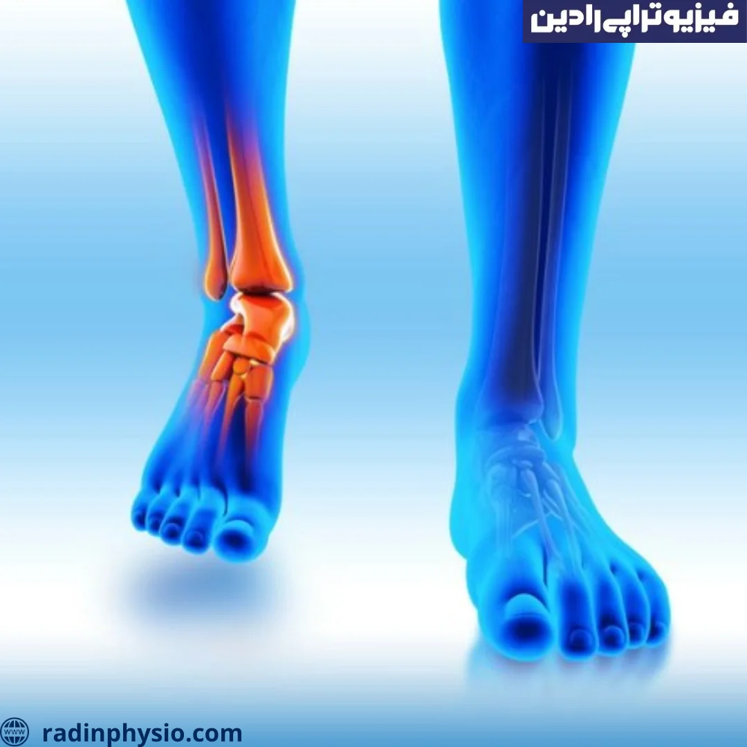 فیزیوتراپی تاندونیت پرونئال چیست؟ کلینیک فیزیوتراپی رادین