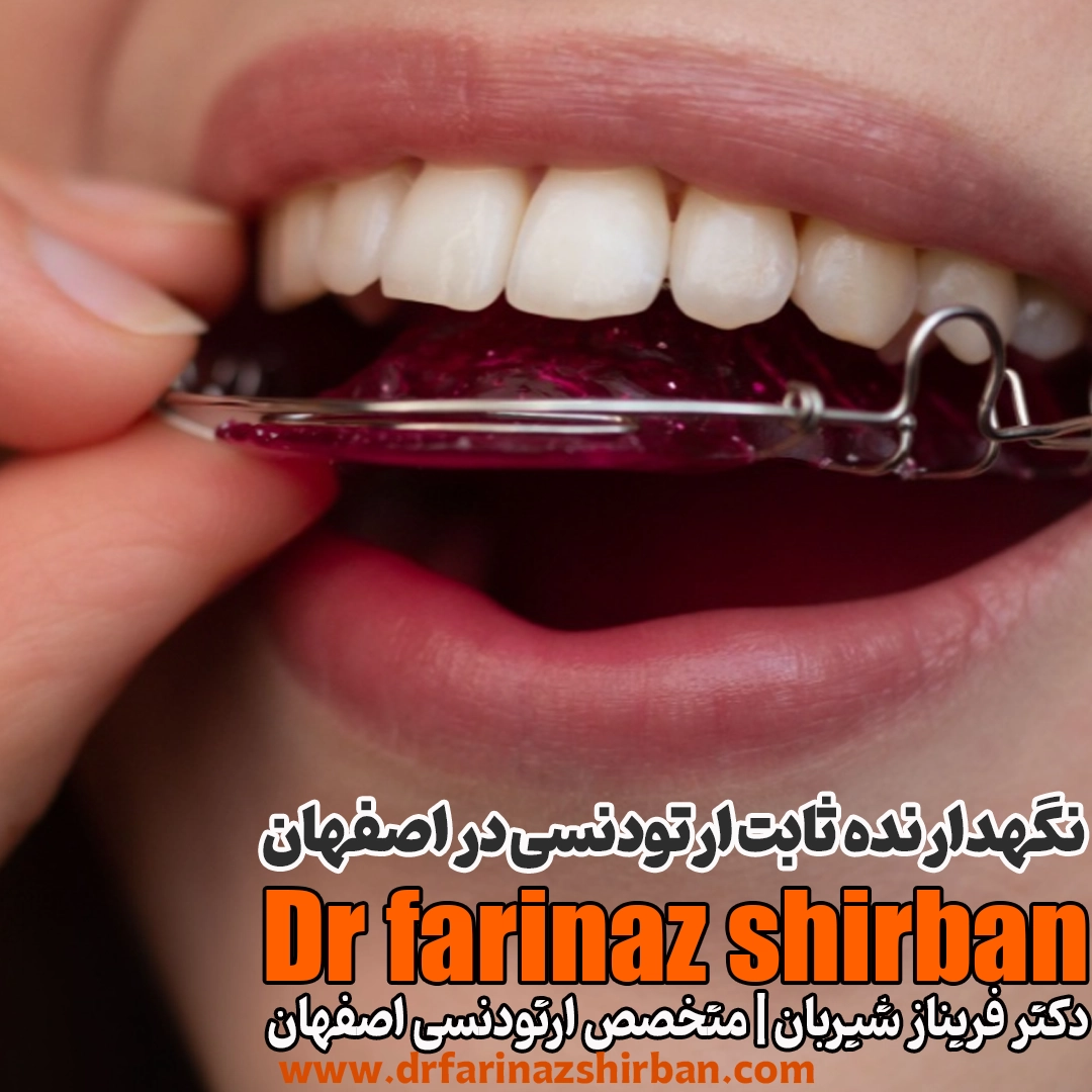 جدول قیمت روز نگهدارنده ثابت یا نگهدارنده سیم ارتودنسی