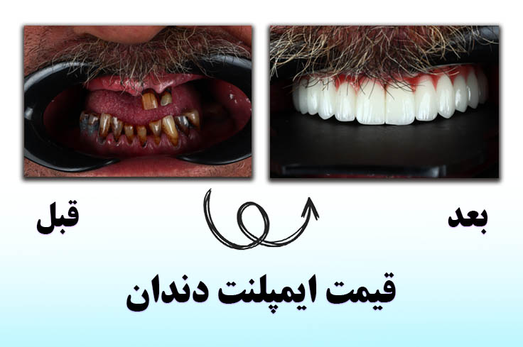 قیمت ایمپلنت دندان 1404 در تهران (قیمت انواع ایمپلنت + روکش)