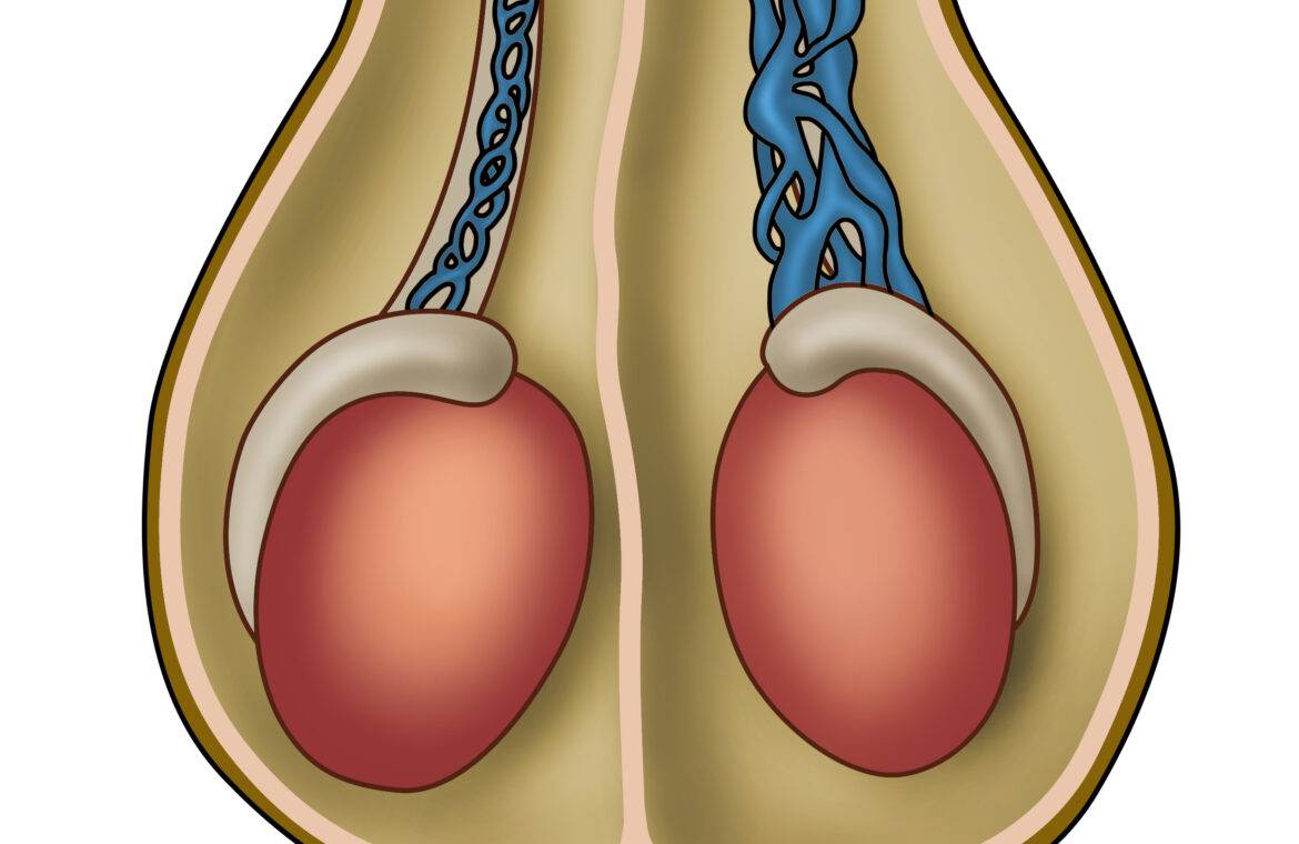 The best way to treat varicocele in men - Jahanshahr Urology Center