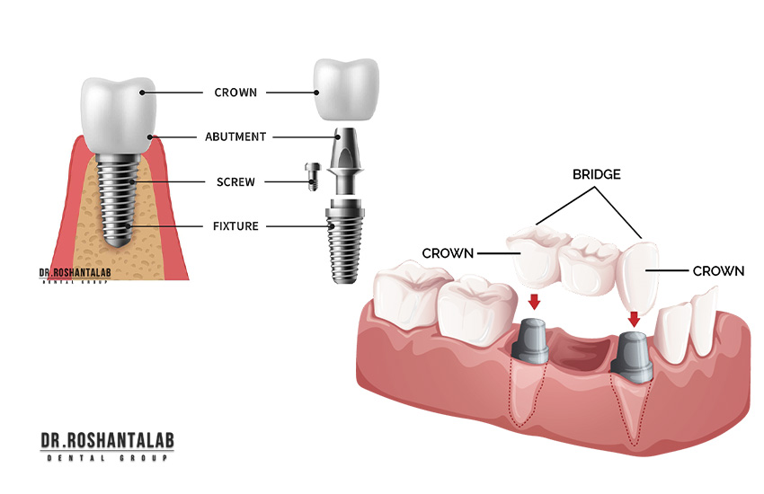 چرا ایمپلنت دندان بهترین راه حل است؟ 6 دلیل برای کاشت ایمپلنت