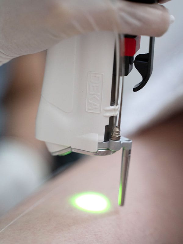 Four important features of the Deca device for laser hair removal - Dr. Mehrdad Timourian, a dermatologist, hair and beauty specialist