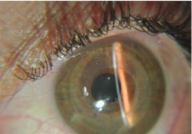 ضخیم شدن قرنیه نازک - دکتر مهرداد محمدپور