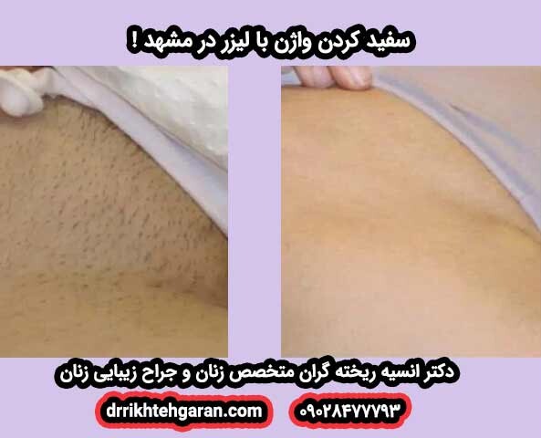 تبييض المهبل بالليزر في مشهد. طريقة آمنة وفعالة ومتخصصة لزيادة الجمال والثقة بالنفس