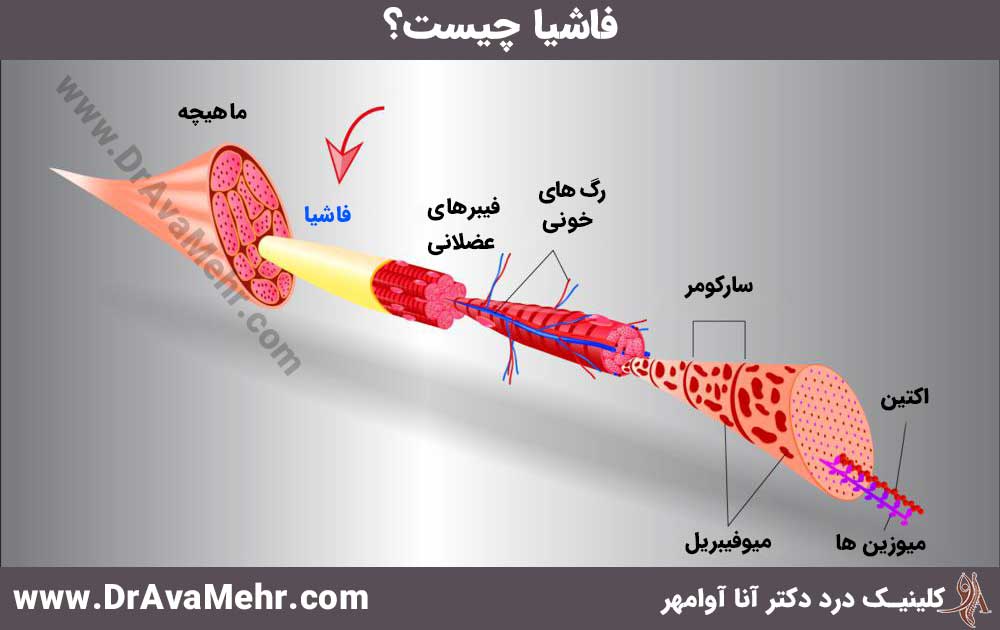 ما هي اللفافة وكيف يتم علاجها؟ - د. آنا أفاميهر