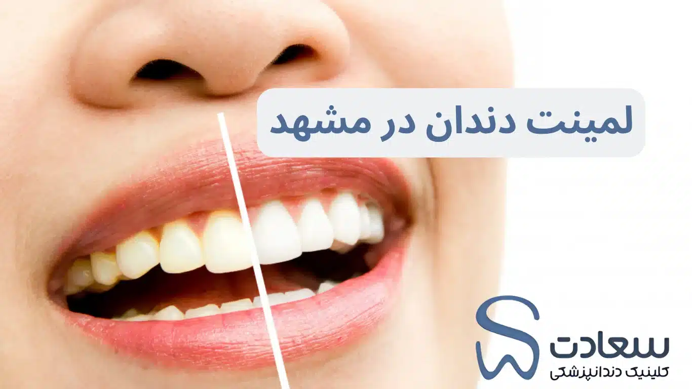 چرا لمینت دندان محبوب ترین درمان زیبایی در مشهد است؟ - کلینیک دندانپزشکی سعادت