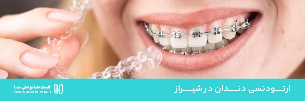 ارتودنسی دندان در شیراز هزینه 1404 انواع + بهترین متخصص ارتودنسی
