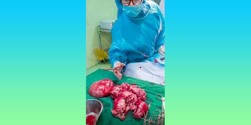 عمل فیبروم رحم توسط دکتر اخوان دکتر صدیقه آخان طبیب متخصص زنان و زایمان