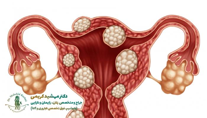 Is uterine fibroid dangerous in pregnancy? (treatment and control solutions)