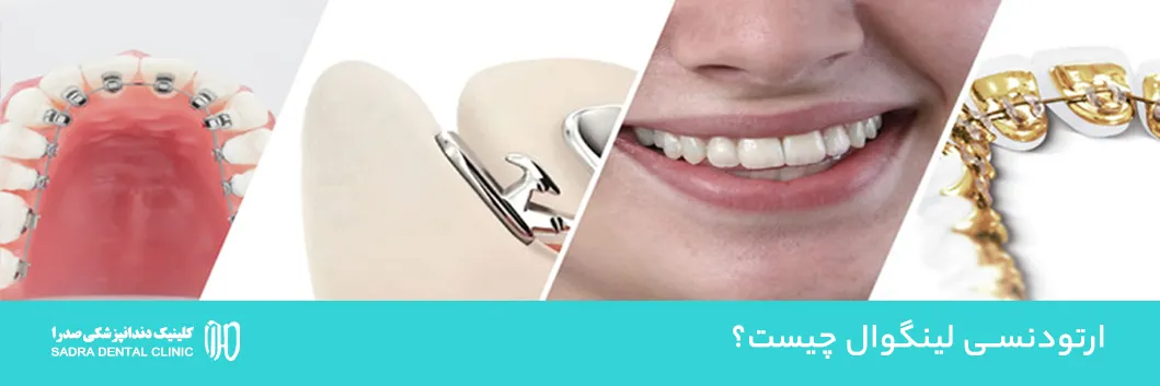 ارتودنسی لینگوال چیست؟ مزایا، معایب، هزینه و مقایسه کامل