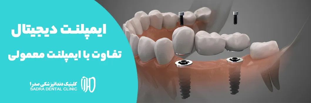 ایمپلنت دیجیتال در شیراز تفاوت با ایمپلنت معمولی مراحل، مزایا و هزینه ها