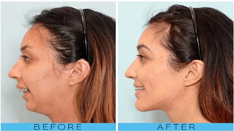 چگونه فرم لب ها بعد از ارتودنسی + درمان تغییر می کند