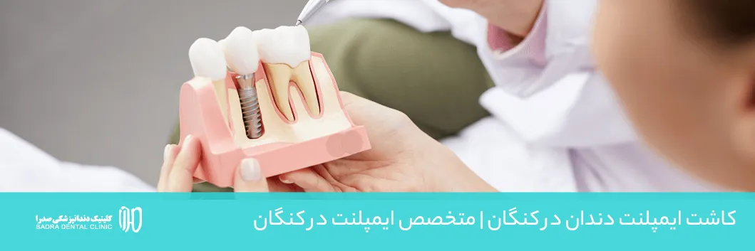 کاشت ایمپلنت دندان در کنگان متخصص ایمپلنت در کنگان