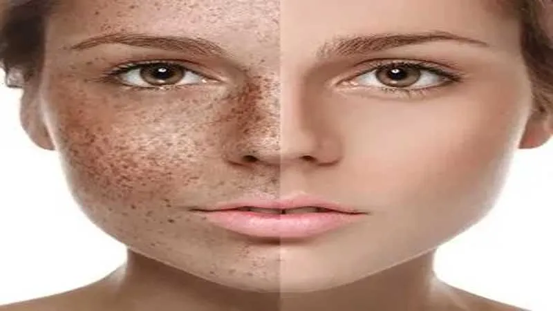 معرفی بهترین راه برای از بین بردن خال و خال بدون جراحی