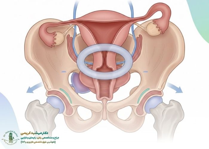 How is non-surgical treatment of uterine prolapse possible?