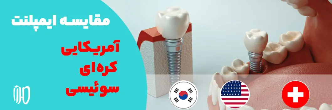 مقایسه ایمپلنت های آمریکایی، کره ای و سوئیسی شیراز، مزایا و هزینه ها