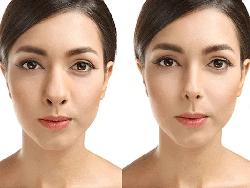 جراحی بینی + عکس نمونه کار