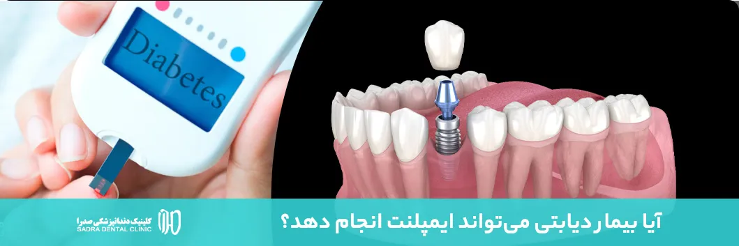 ایمپلنت و دیابت شیراز مشاوره رایگان بیماران دیابتی کلینیک دندانپزشکی صدرا