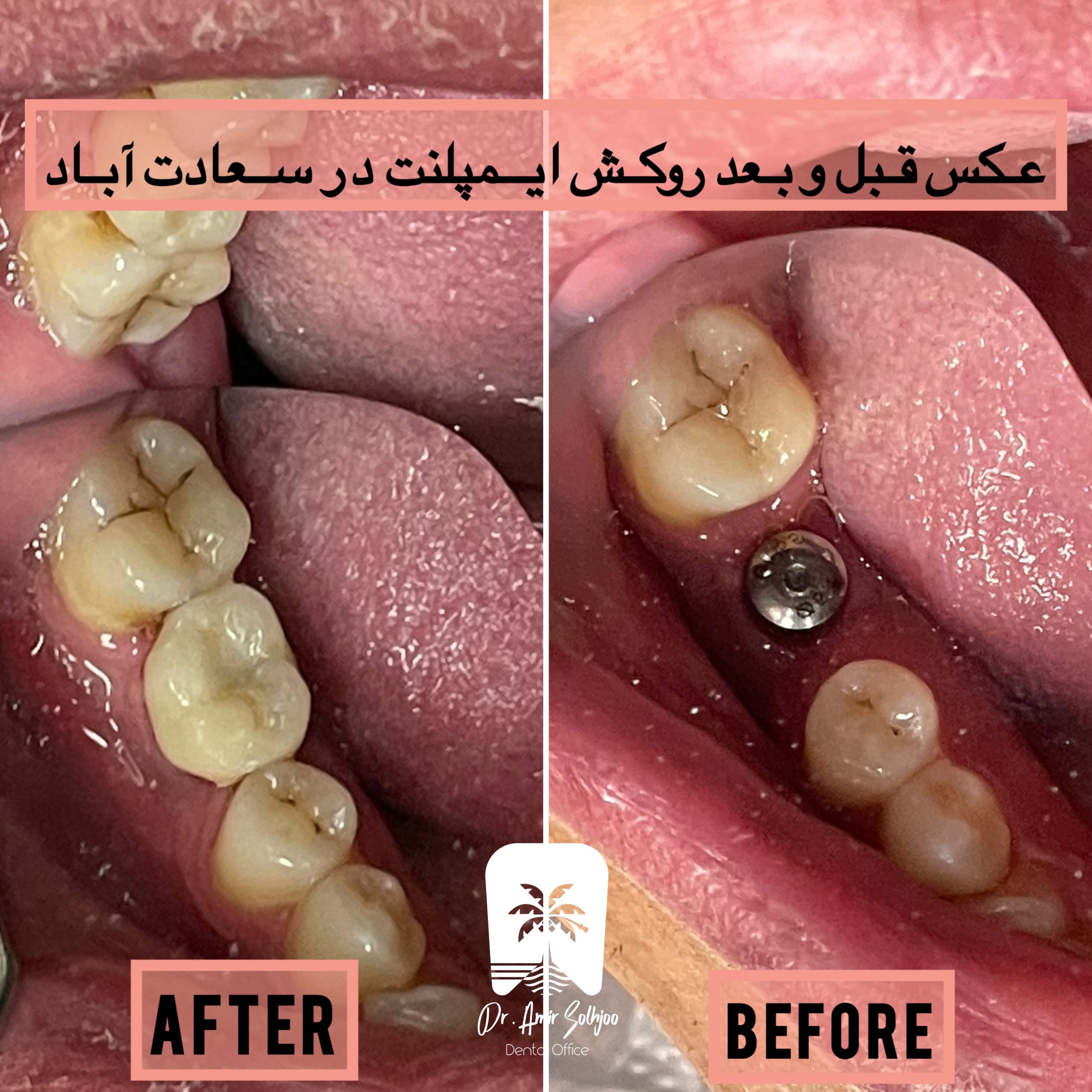 زراعة الأسنان في مرزداران