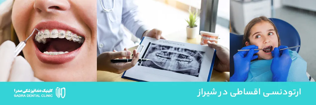ارتودنسی اقساطی در شیراز بدون سود مشاوره رایگان هزینه اقساط ارتودنسی کودکان