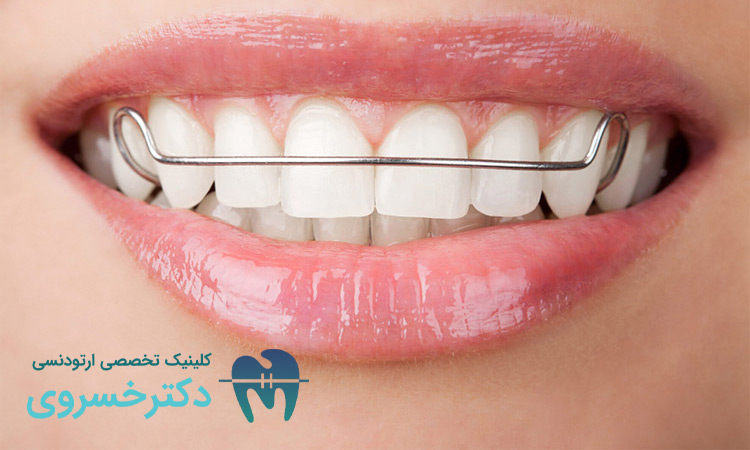 ارتودنسی متحرک برای چه دندان هایی مناسب است؟