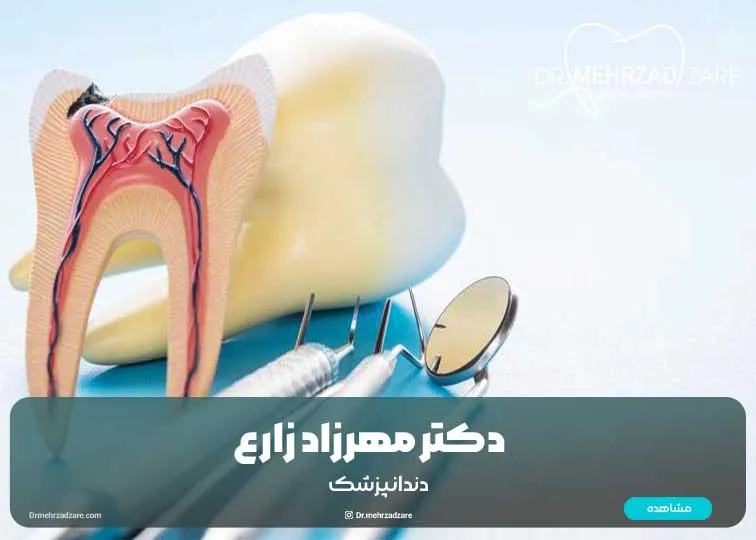 مراقبت های بعد از درمان ریشه