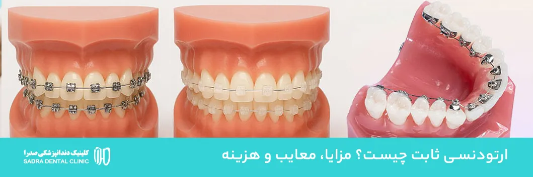 ارتودنسی ثابت چیست؟ راهنمای کامل + مزایا، معایب و هزینه در 1404 شیراز