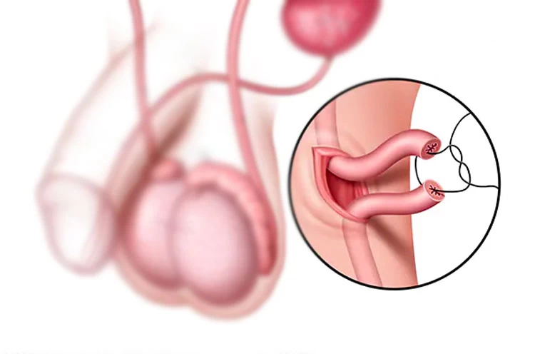 همه چیز درباره جراحی وازکتومی - مرکز اورولوژی جهانشهر