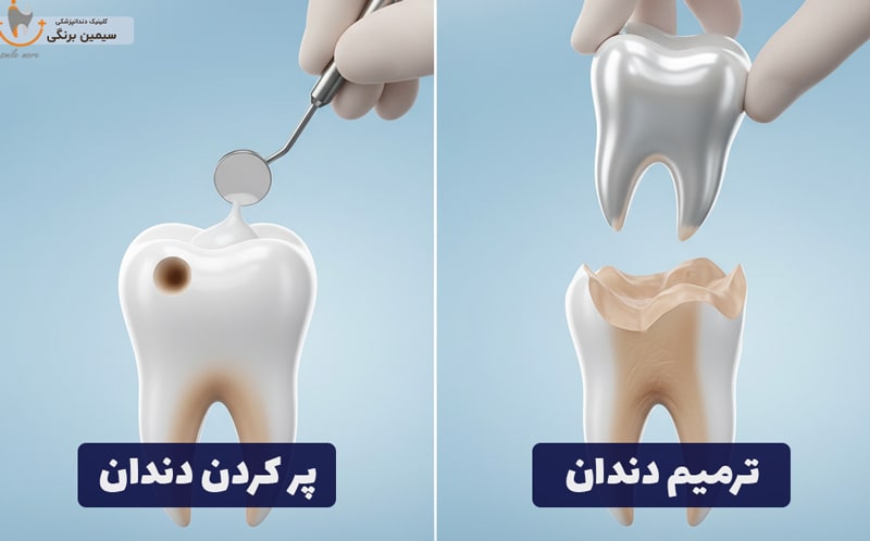 5 differences between tooth filling and tooth restoration + benefits, cost Simin Barangi