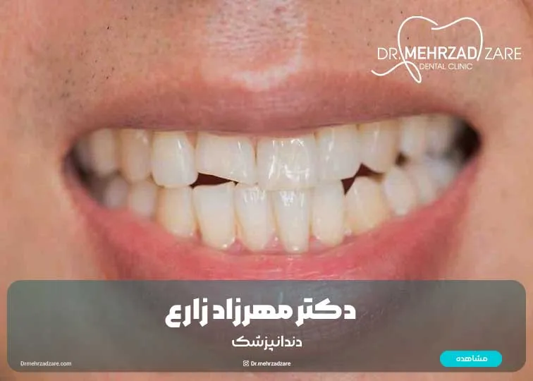 Methods to restore chipped teeth: a complete guide to smile restoration