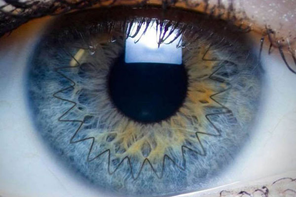 پیوند قرنیه و کراتوپلازی چیست و برای چه کسانی مناسب است؟