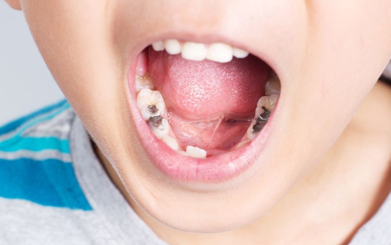 Filling children's teeth and repairing baby teeth colored cement