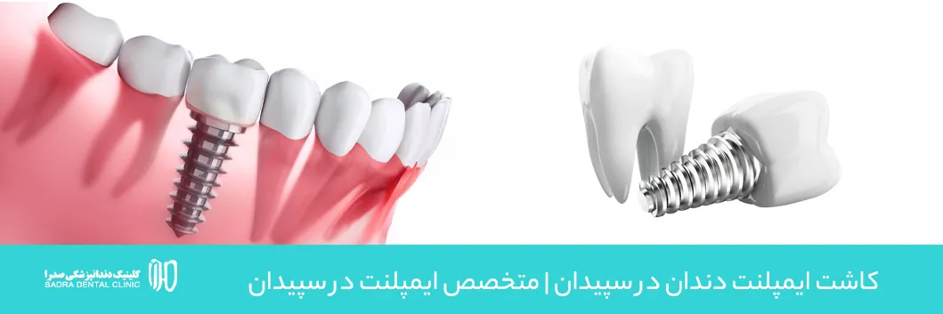 کاشت ایمپلنت دندان در سپیدان متخصص ایمپلنت در سپیدان